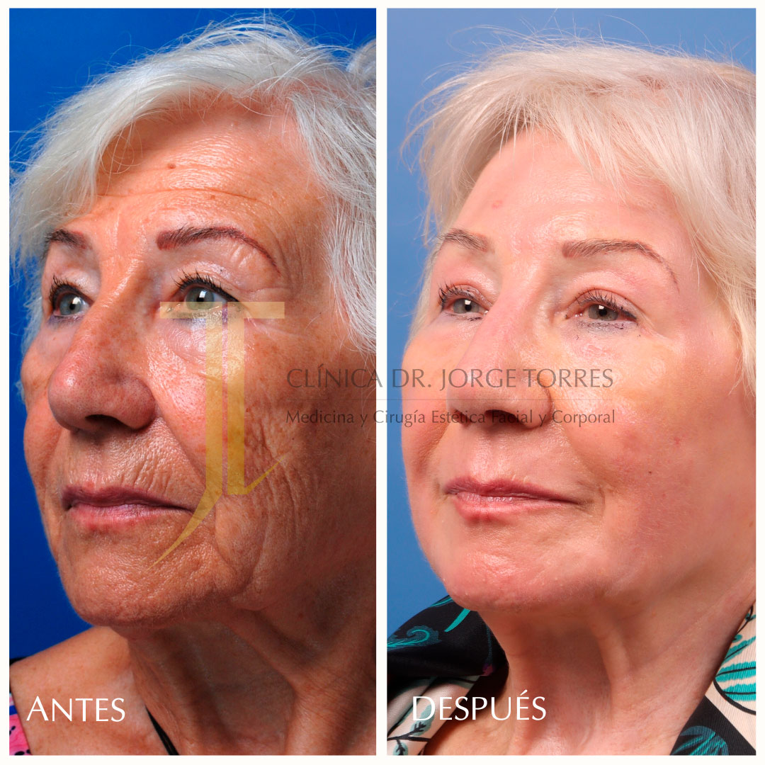 PEELING PROFUNDO 